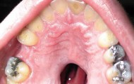 Hole in the palate for cocaine