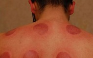 Cupping, cupping in the Eastern