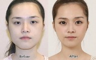 28 Crazy before and after photos of korean plastic surgery