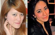 Girl with new face thanks to plastic surgery