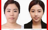 Total plastic surgery in South Korea. Incredible photos of patients before and after