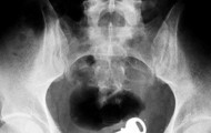 17 X-ray images, which prove that idiots are perverts