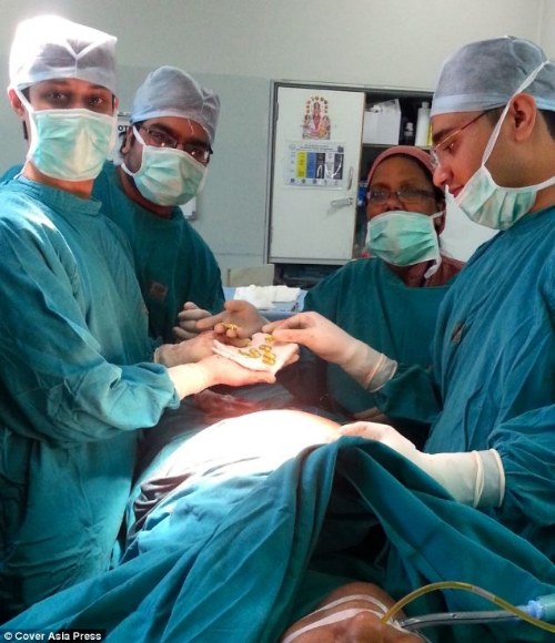 gold found stomach