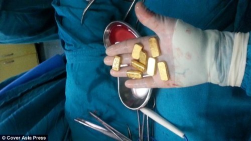gold found stomach