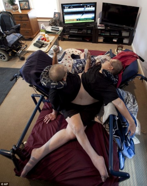 oldest conjoined twins 